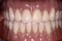 Herausnehmbarer Zahnersatz Totalprothese