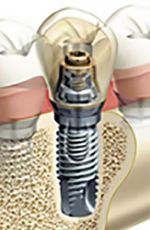Implantat Implantologie Zahnarzt Aachen Praxis