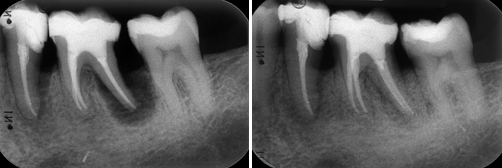 Abbau des Zahnhalteapparates Regenrative Parodontaltherapie