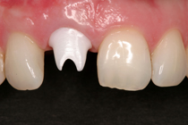 Implantataufbau Behandlungsablauf Zahn Zahnarzt