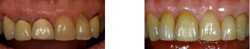 Optimierung Zahnfleischverlauf Parodontologie Aachen