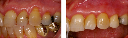 Wiederaufbau Zahnfleisch Zahnfleischdefekte