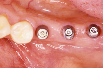 zahn implantate Implantatnachsorge Zahnaufbau