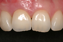 Implantataufbau Behandlungsablauf Zahn Zahnarzt Nachher