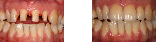 Vollkeramische Zahnversorgung CAD-CAM Verfahren