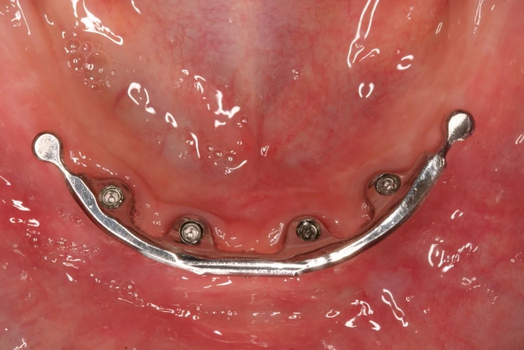 Implantatgetragener Steg im Unterkiefer